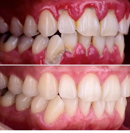 Tartrectomía o limpieza dental