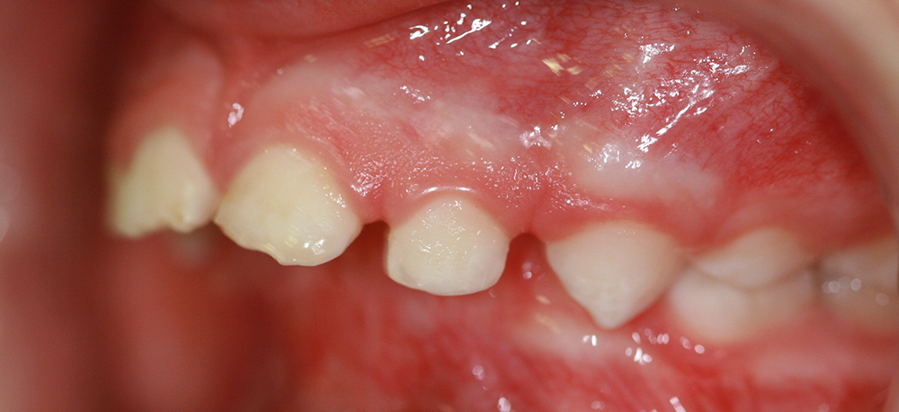 Ortopedia dentofacial antes caso 11
