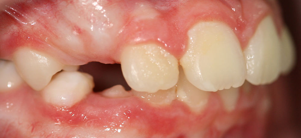 Ortopedia dentofacial después caso 12