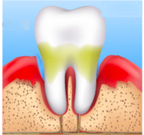 esquema periodontitis