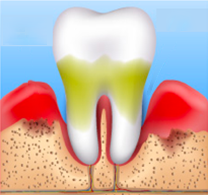 esquema periodontitis avanzada