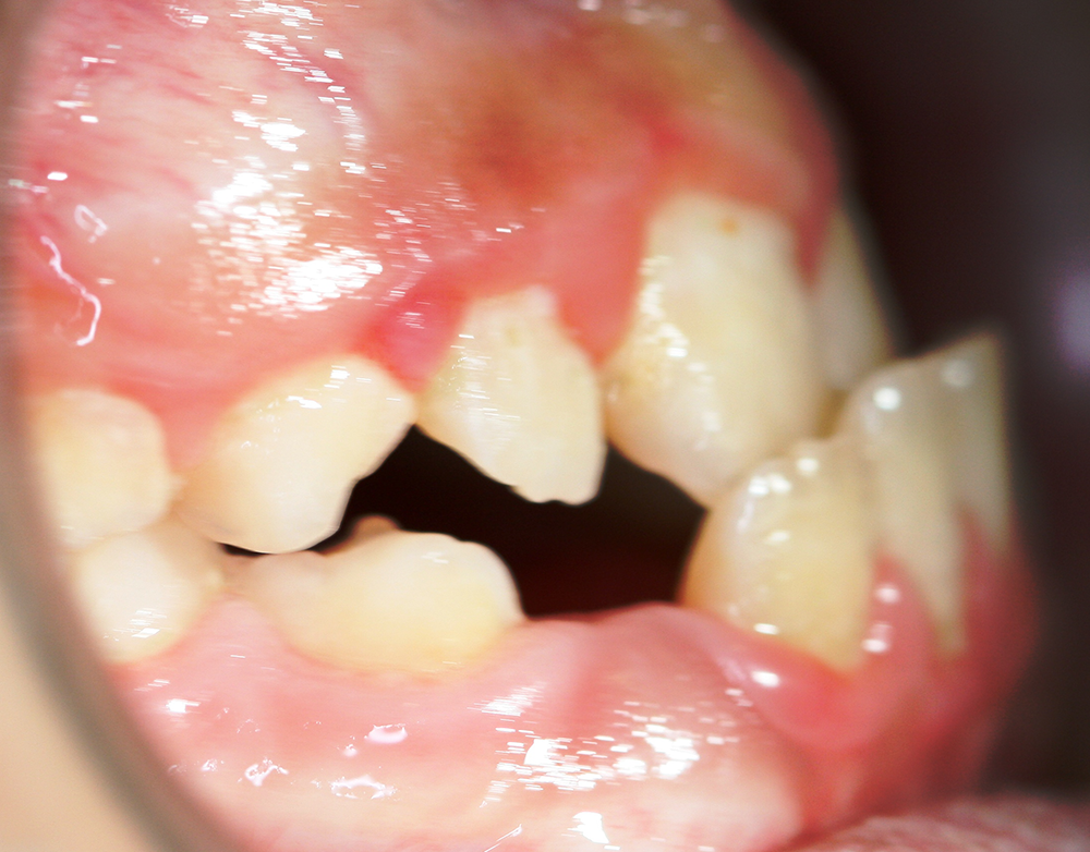 Ortopedia dentofacial antes caso 7
