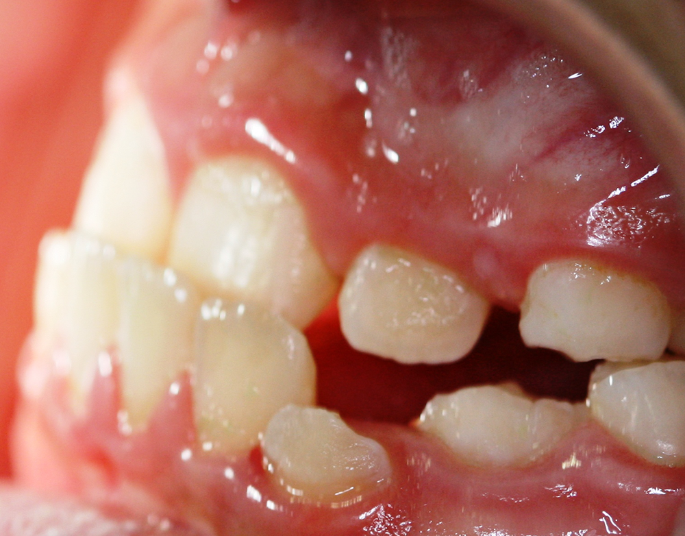 Ortopedia dentofacial antes caso 7