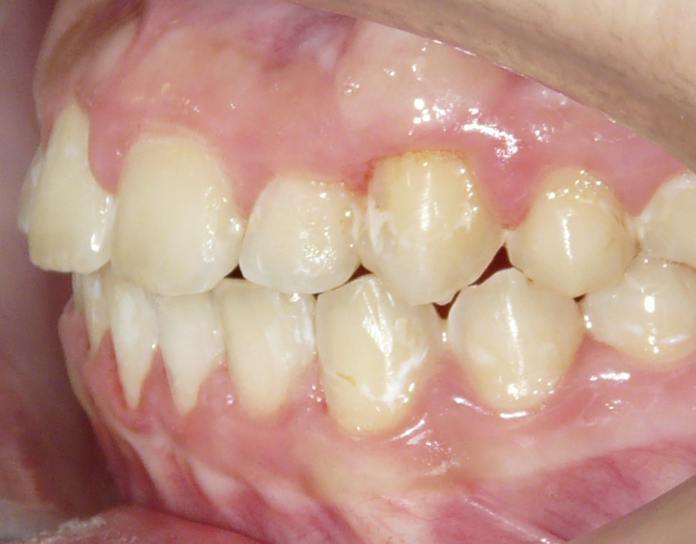 Ortopedia dentofacial después caso 7