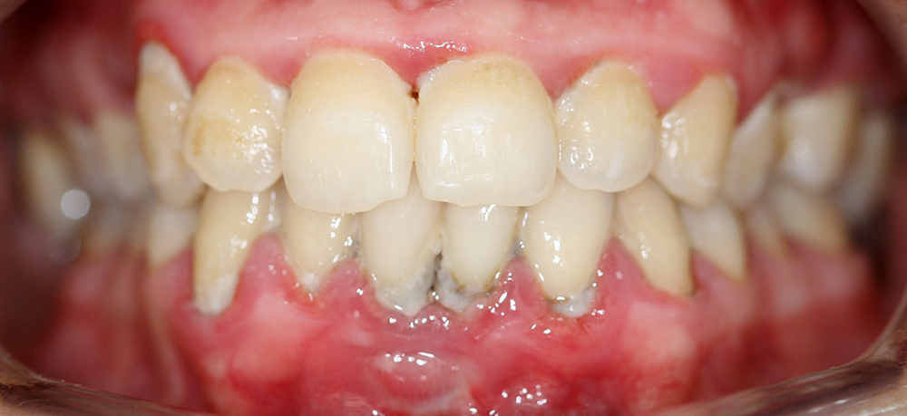 odontología conservadora antes caso 2