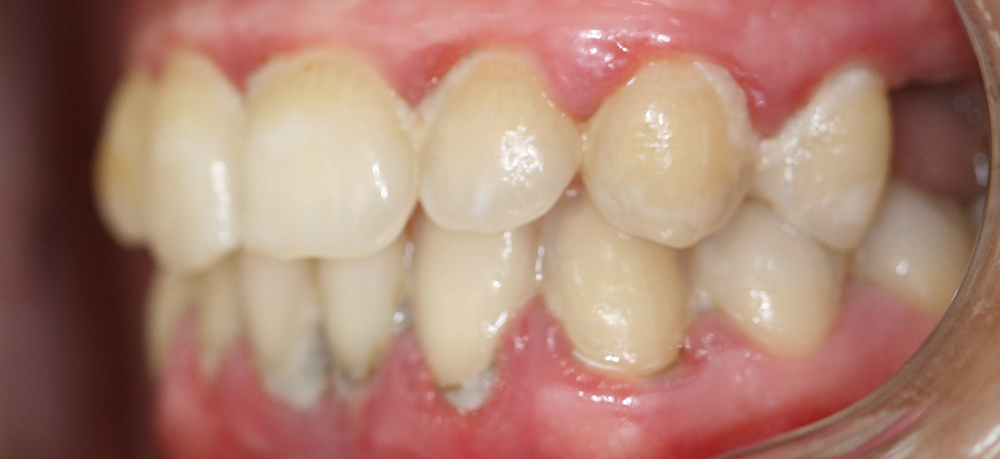 odontología conservadora antes caso 3