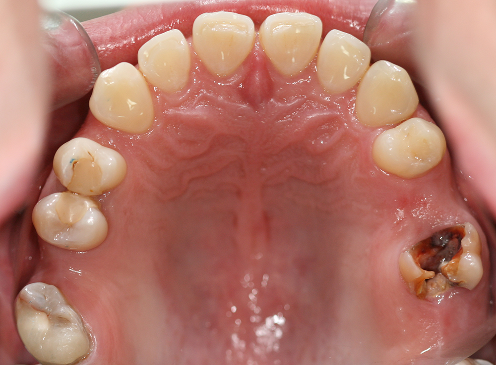 odontología conservadora antes caso 4