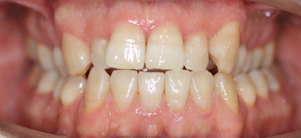 ortodoncia antes caso 2