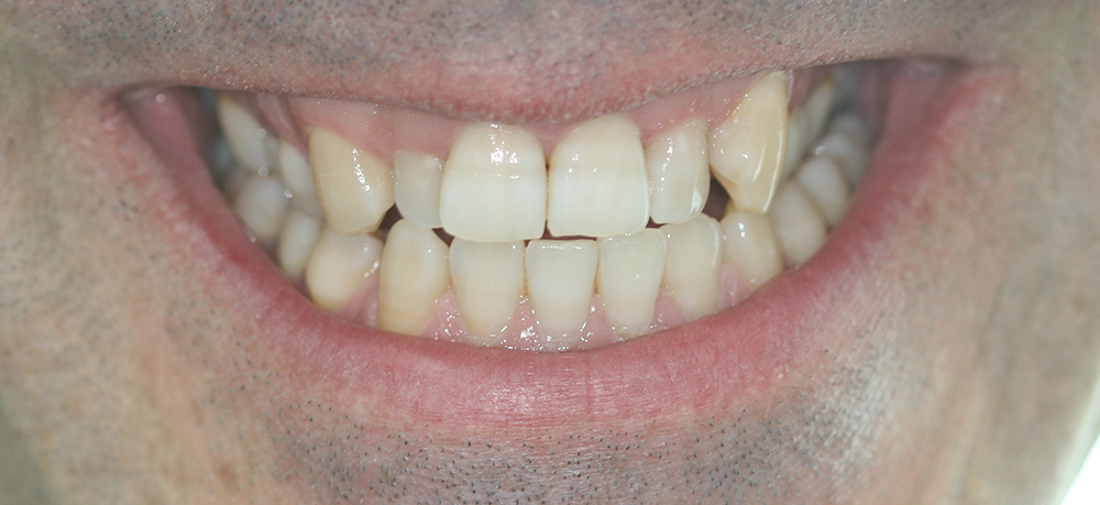 ortodoncia antes caso 3