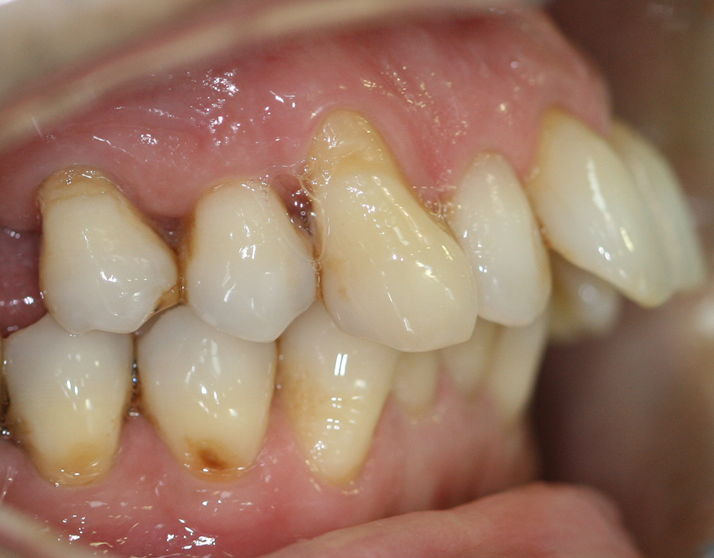 ortodoncia antes caso 4