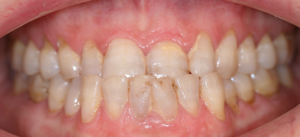 ortodoncia antes caso 5