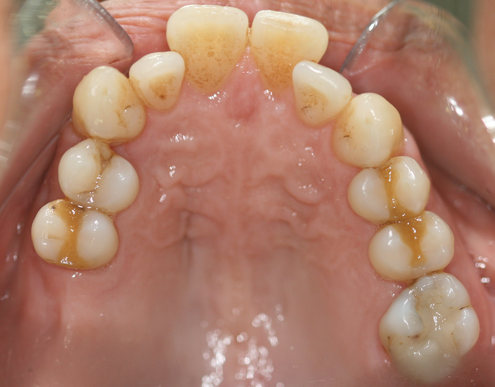 ortodoncia antes caso 6