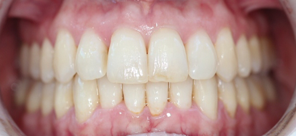 ortodoncia después caso 1