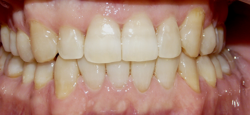 ortodoncia después caso 2