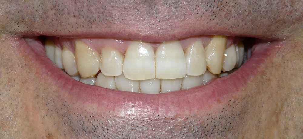 ortodoncia después caso 3
