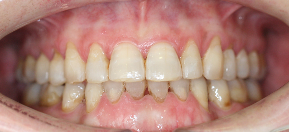 ortodoncia después caso 5