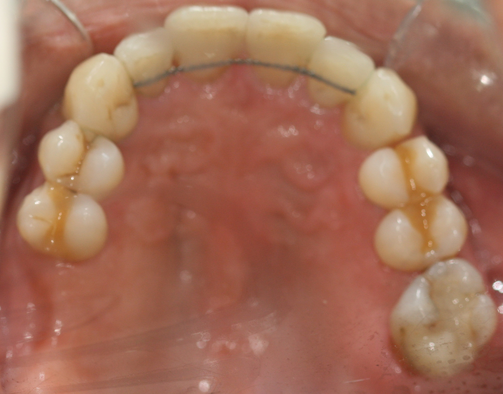 ortodoncia después caso 6
