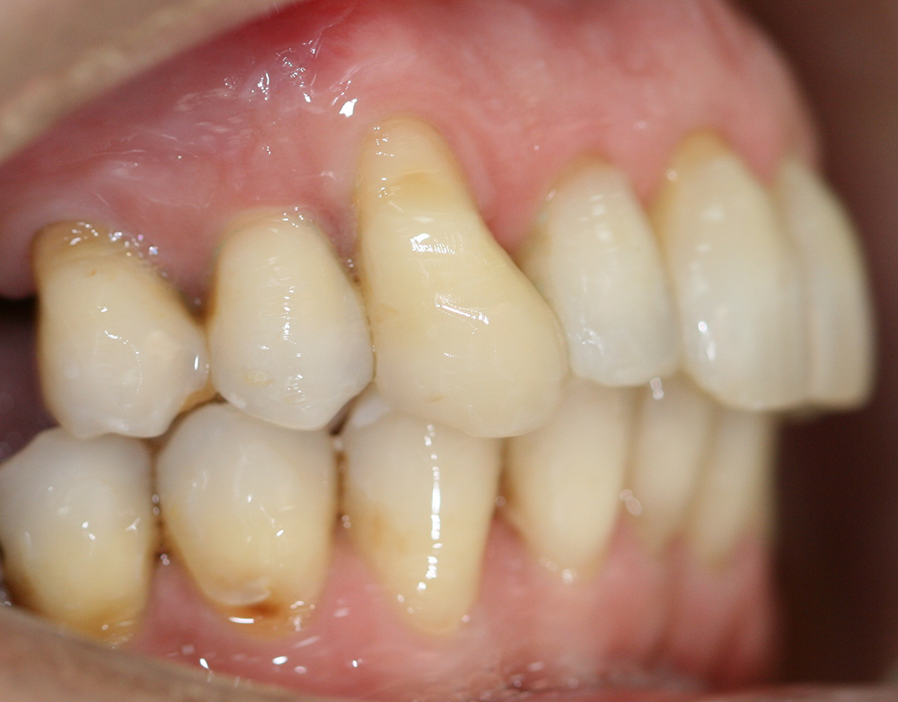 ortodoncia después caso 4