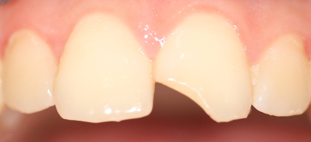 odontología conservadora reconstrucción antes 1