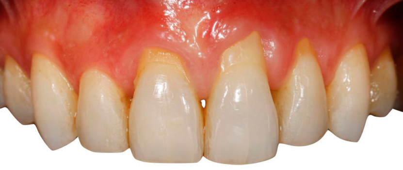 Tratamiento periodontitis antes