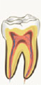 nervio de diente sano