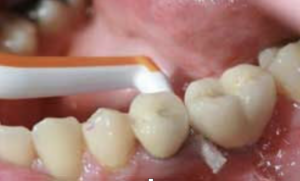 limpieza interdental entre diente y corona