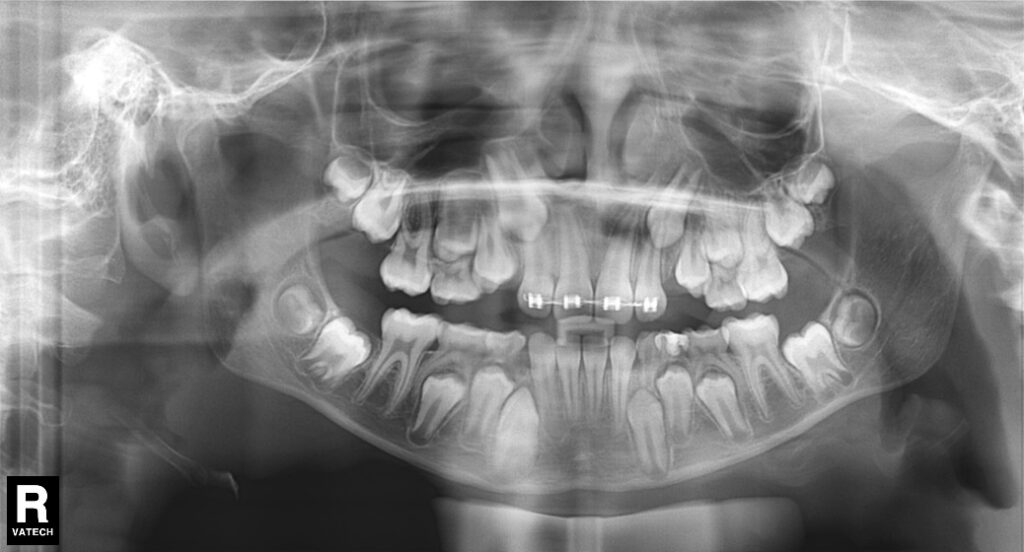 Cirugía oral Exodoncia de dientes retenidos o fenestraciones