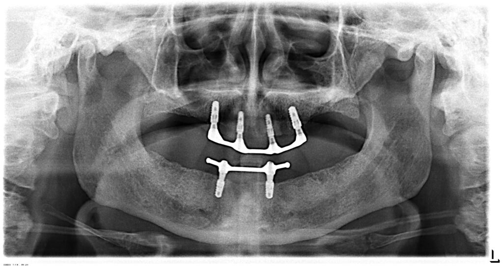radiografía prótesis sobre implantes después