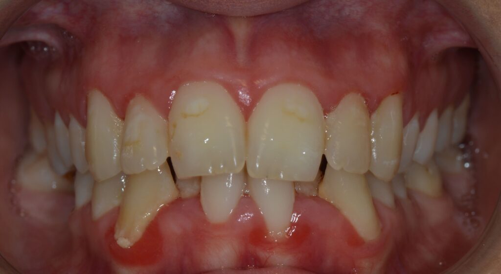 ortodoncia 11 antes