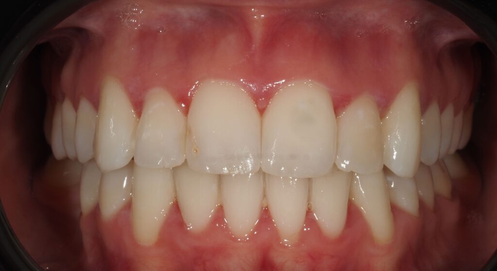 ortodoncia 11 después