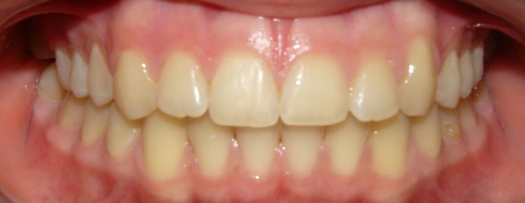 ortodoncia 13 después