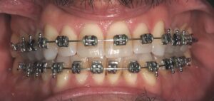 ortodoncia 4-1 brackets